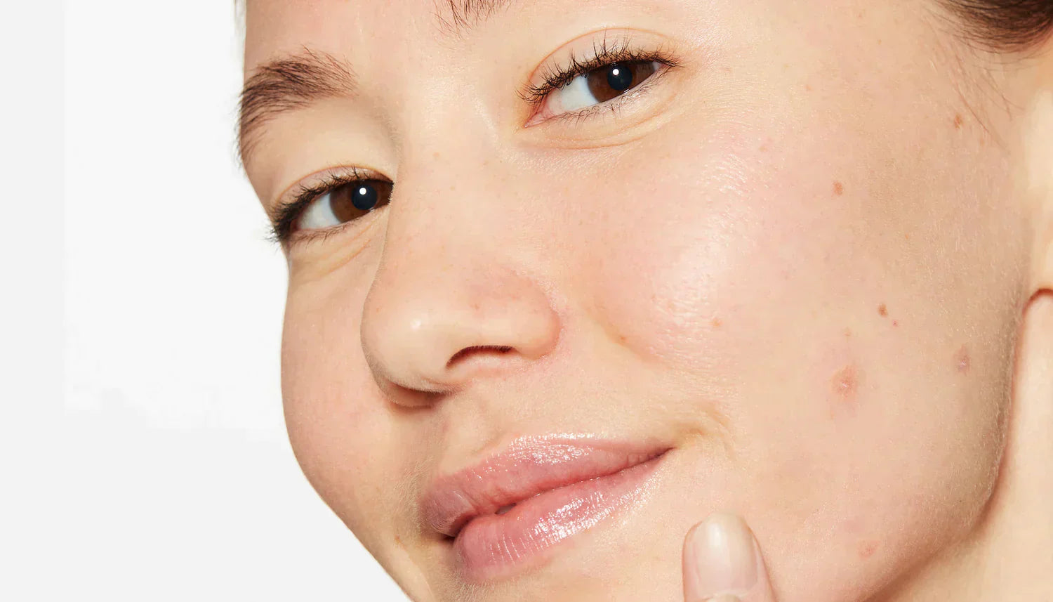 Localised Spots types of spots and how to treat them – Dermalogica Singapore
