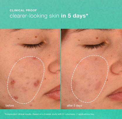 breakout biotic moisturizer